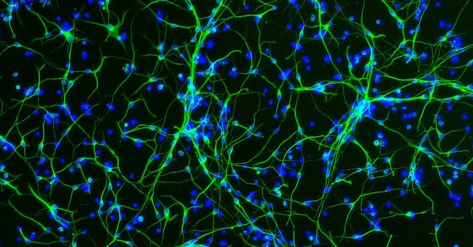 Aging Women’s Brain Mysteries Are Tested in Trio of Studies