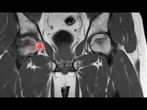 Hip Labral Tear Symptoms
