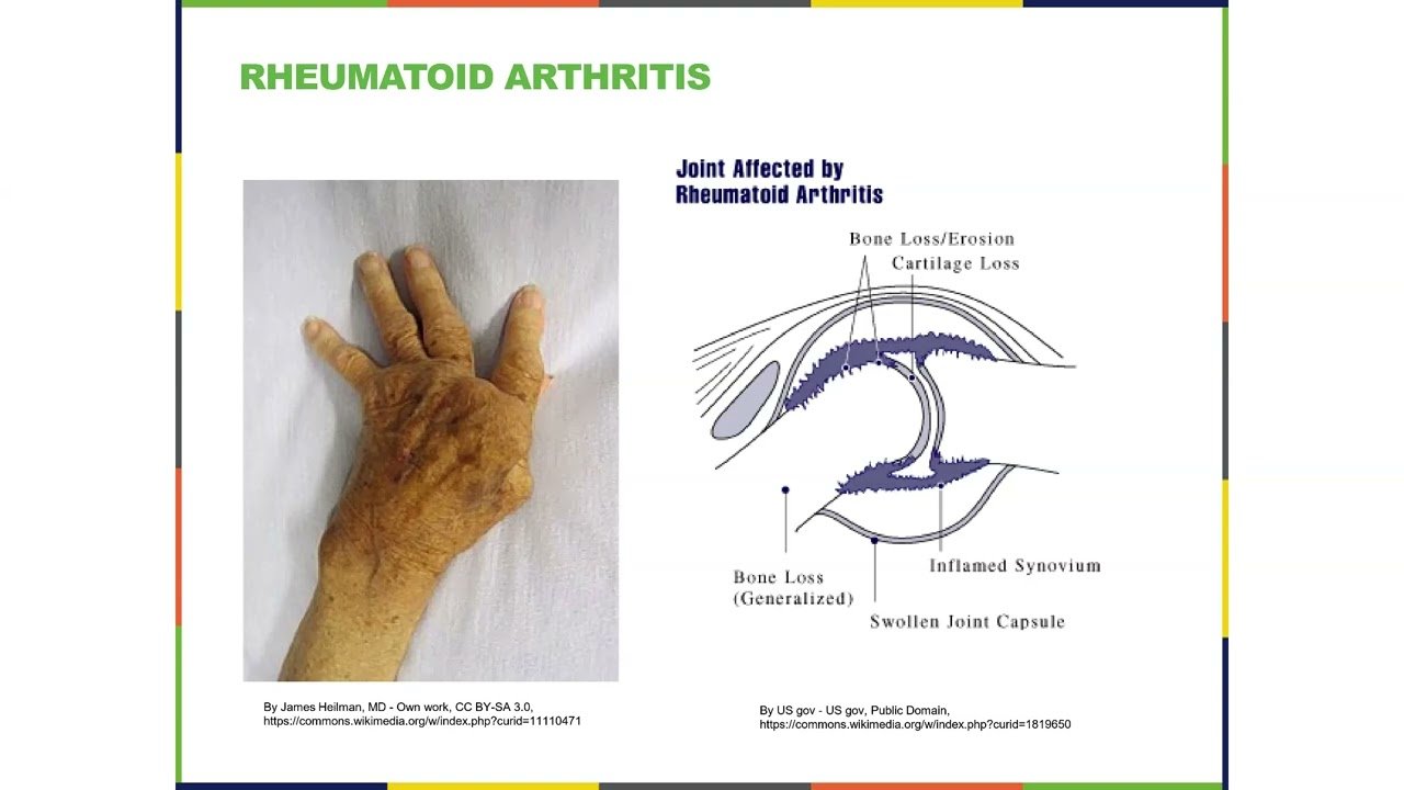 Hip Osteoarthritis Symptoms