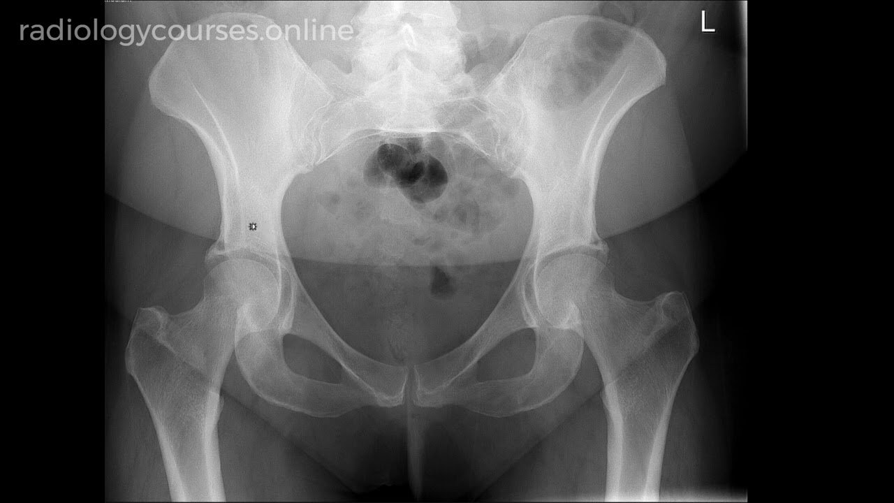 Hip Pain Diagnosis